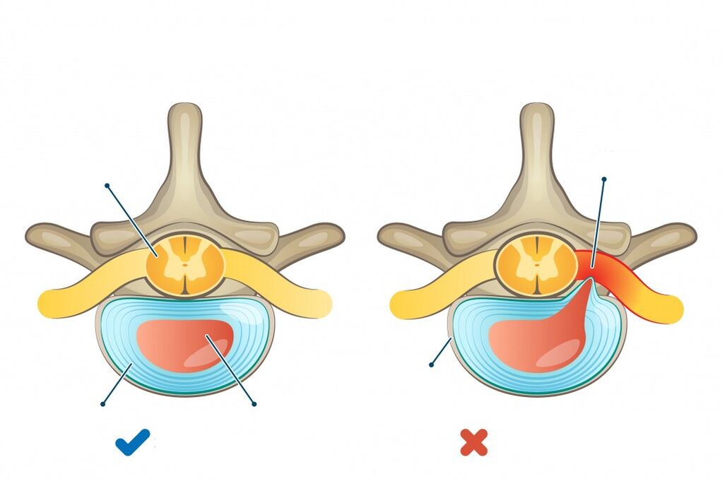 intervertebral discs - one healthy, the other herniated