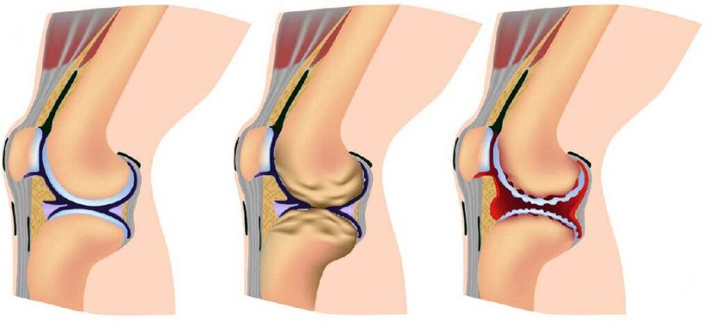 Healthy and affected by arthritis
