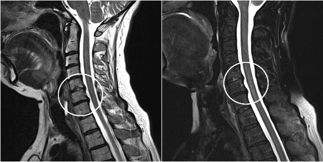 cervical osteochondrosis on MRI imaging