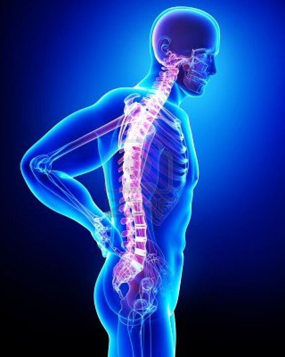 Human back affected by osteochondrosis