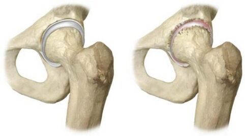 healthy joint and affected by arthrosis